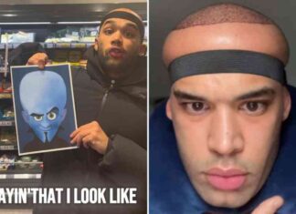 hair-transplant-side-effect-leaves-british-man-horrified-look