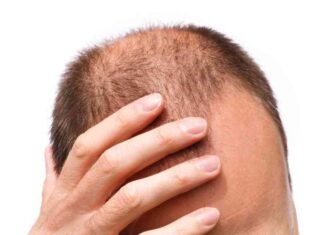 common-misconceptions-about-hair-transplant-surgery-what-to-know