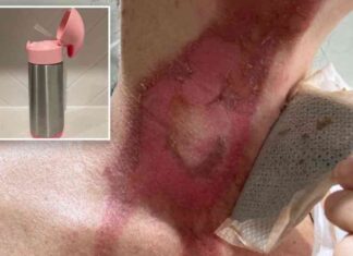 warning-moms-excruciating-burn-cleaning-product-caution