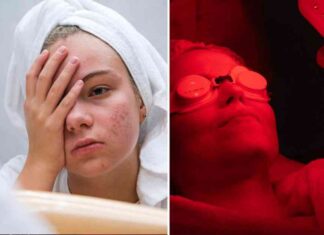 study-red-light-therapy-for-acne-effective-or-not