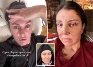 nose-job-and-eyelid-surgery-before-wedding-my-6k-experience