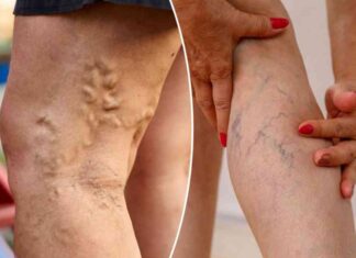 understanding-varicose-veins-vs-spider-veins-key-differences-and-treatment-options